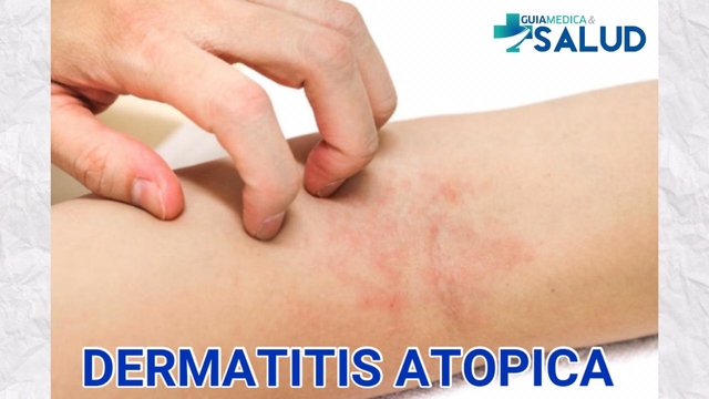 DERMATITIS ATÓPICA - DR. JAVIER MONTIEL 
