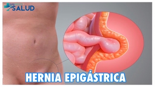 HERNIA EPIGÁSTRICA - DR. PEDRO CHAMORRO