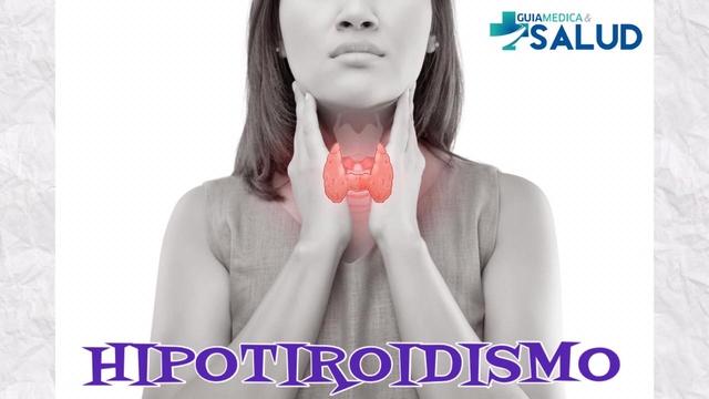 HIPOTIROIDISMO Otros nombres: Hiperfunción Tiroidea, Hipertireosis, Tiroidismo, Tirotoxicosis. - Dra. Gabriela Castilho