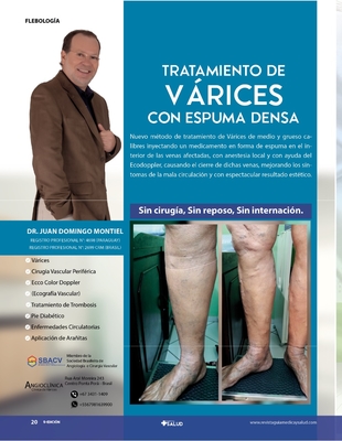TRATAMIENTO DE VÁRICES CON ESPUMA DENSA