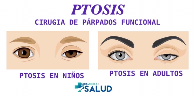 PTOSIS Cirugía de Párpados Funcional - DRA. MIRTHA RAMIREZ