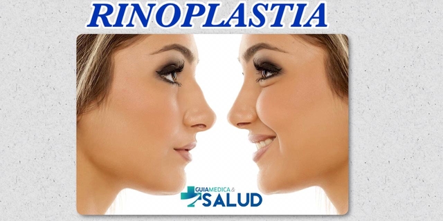 RINOPLASTIA - DR. LUCAS DIAZ DE VIVAR 