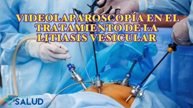 VIDEOLAPAROSCOPÍA EN EL TRATAMIENTO DE LA LITIASIS VESICULAR - DR. LUIS FERNANDO RAMOA GONZÁLEZ