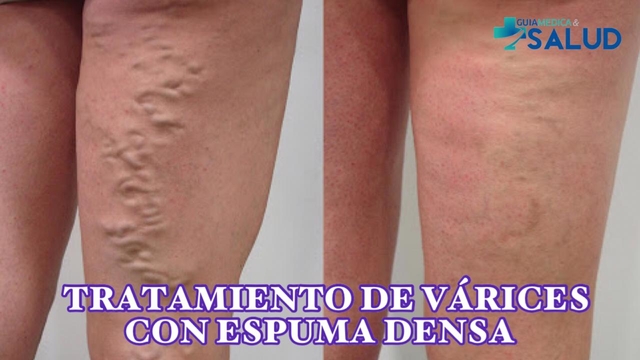 TRATAMIENTO DE VÁRICES CON ESPUMA DENSA - DR. JUAN DOMINGO MONTIEL