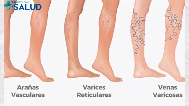 VÁRICES - DR. OSVANI GÁMEZ